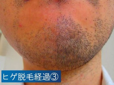 ヒゲ脱毛経過３