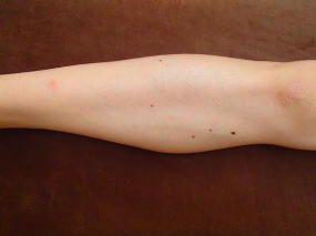 すね毛脱毛前後