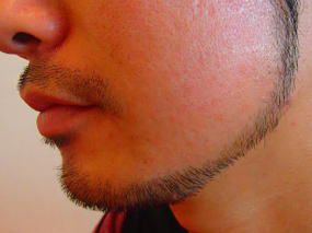 あごひげ脱毛後