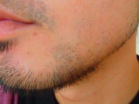 鼻下のひげ脱毛後