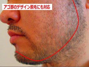 あごひげ脱毛前