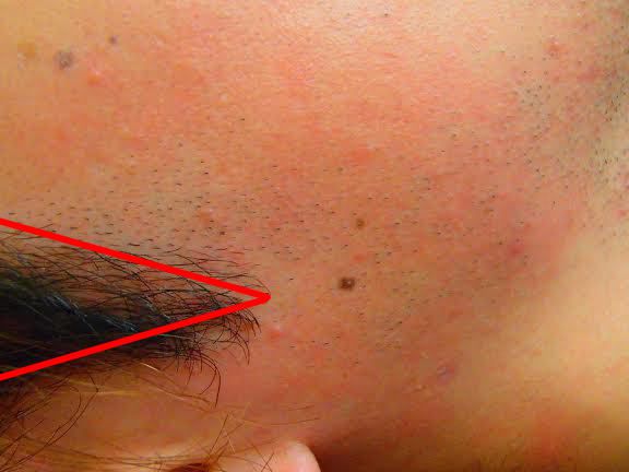 もみあげ脱毛前