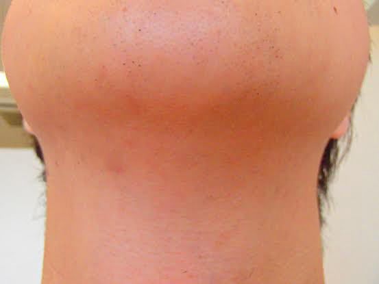 あご裏のひげ脱毛後