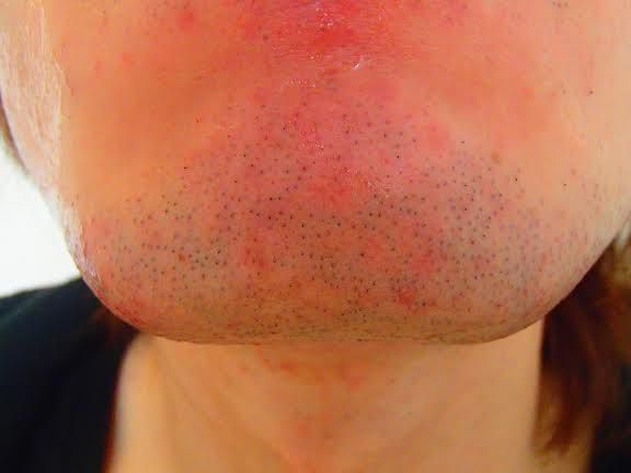 あごひげ脱毛前