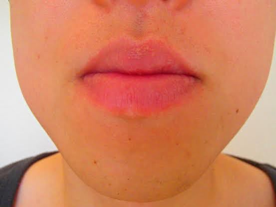 口周りのひげ脱毛後