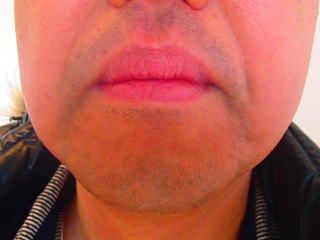 口周りのひげ脱毛前