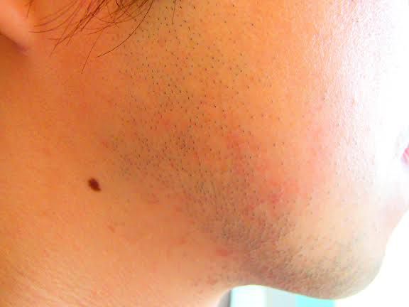 もみあげ脱毛前