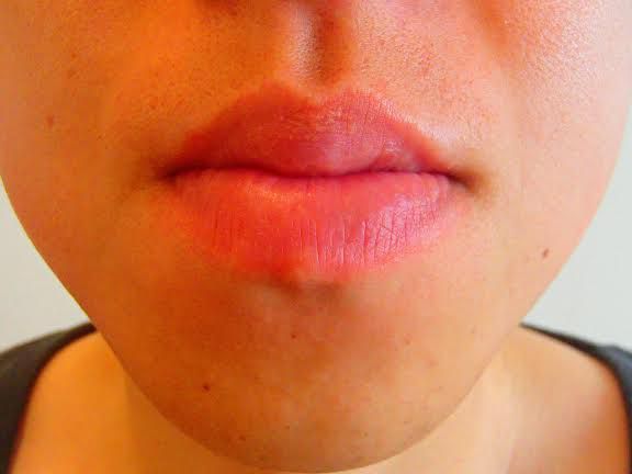 あごひげ脱毛後