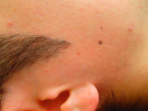 もみあげ脱毛後