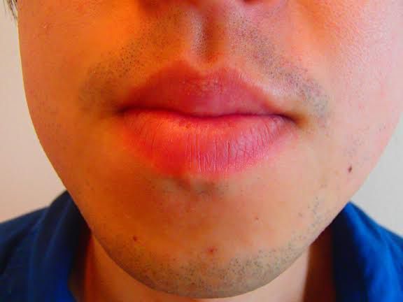 あごひげ脱毛前