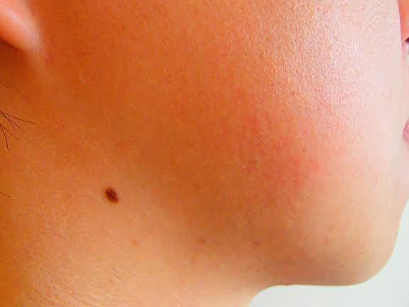 もみあげのひげ脱毛後