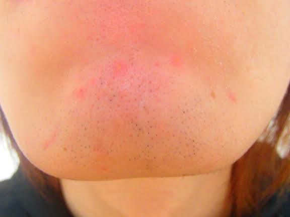 あごひげ脱毛後